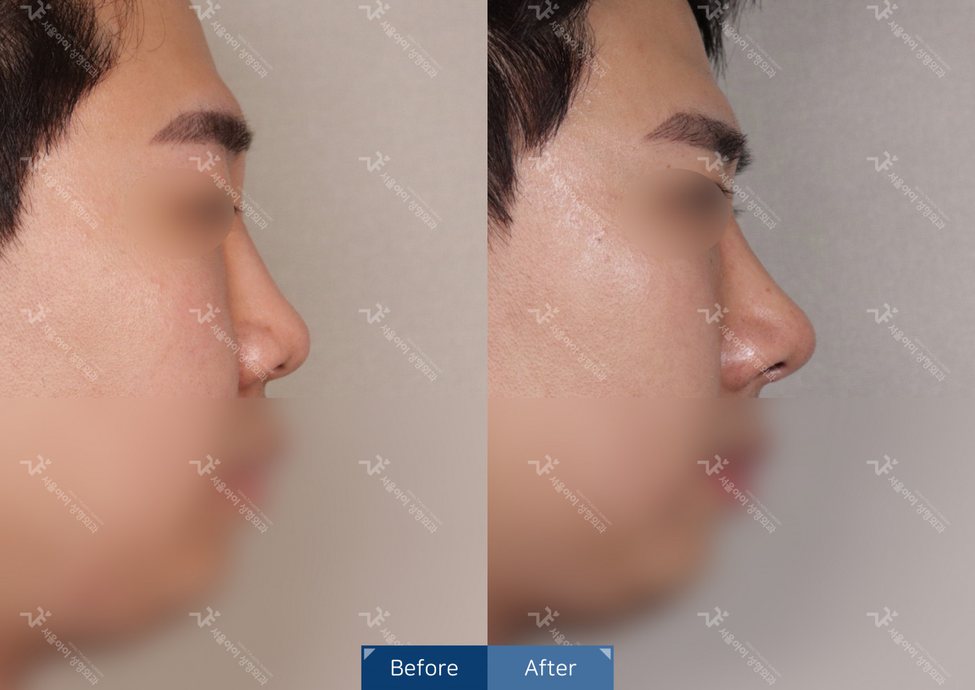 코성형 [코끝조각술+비중격+복코+메부리코]
