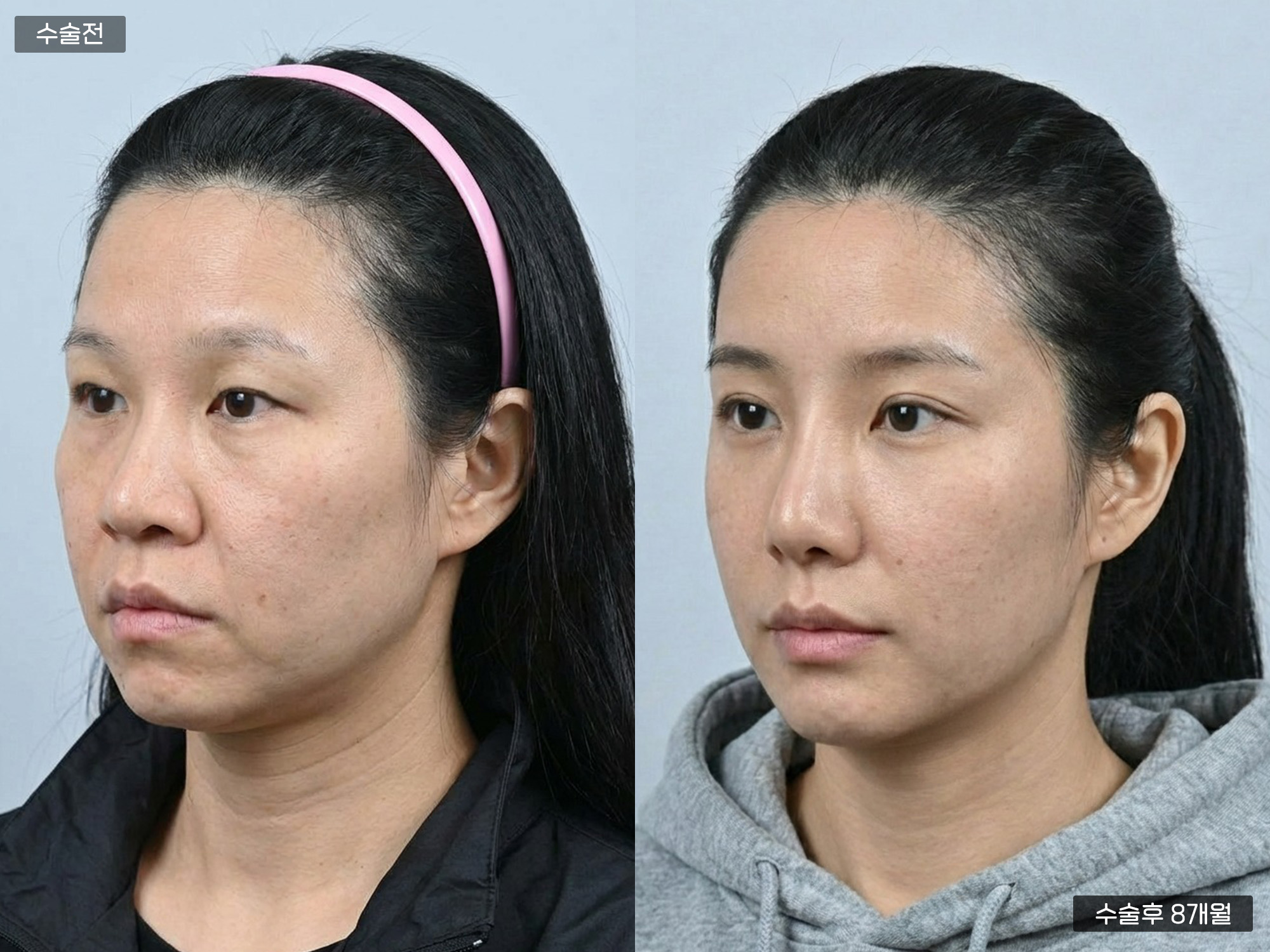 안면거상 + 눈 +코(자가늑) + 지방이식