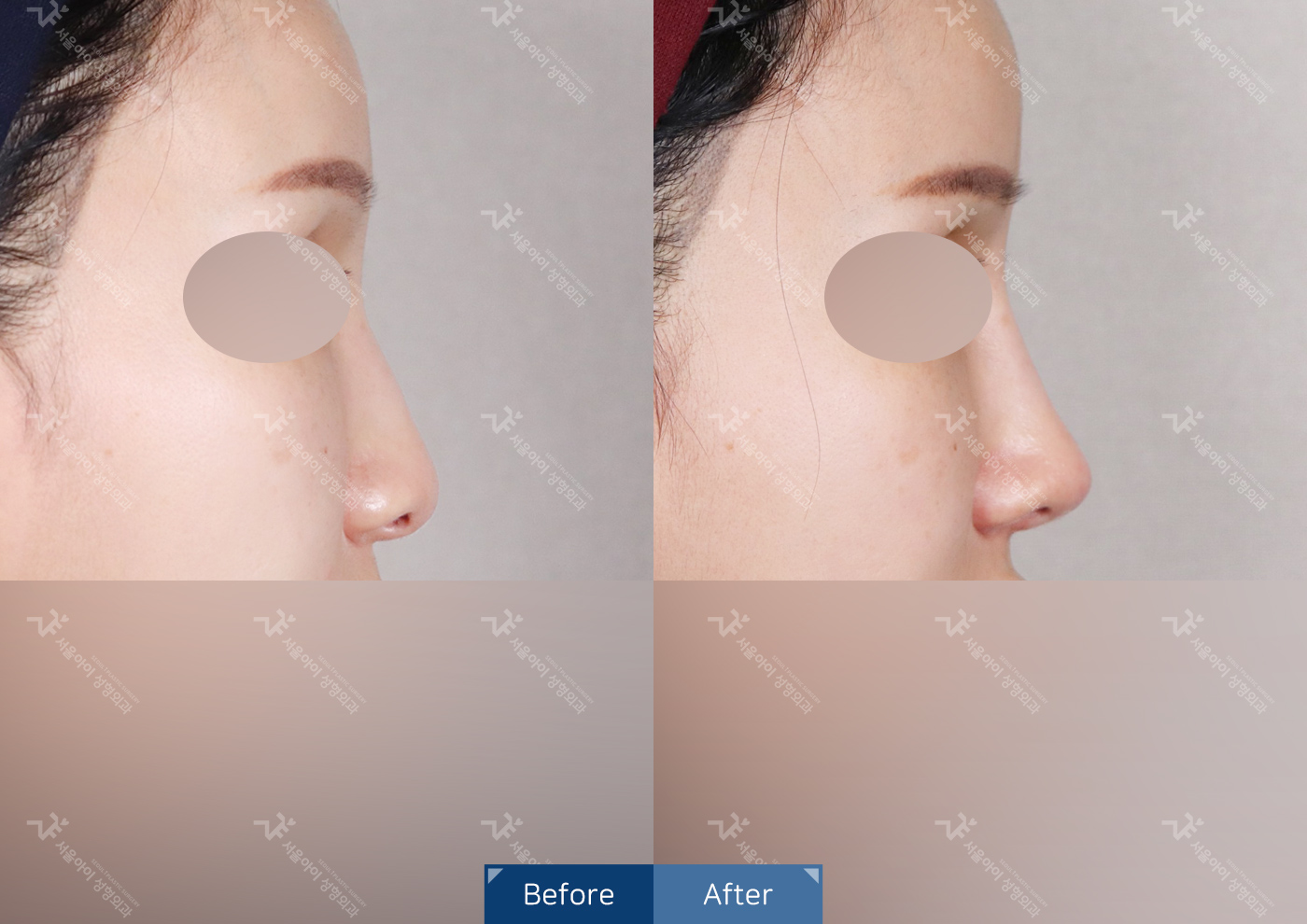 코성형[기능3종 + 미용코]