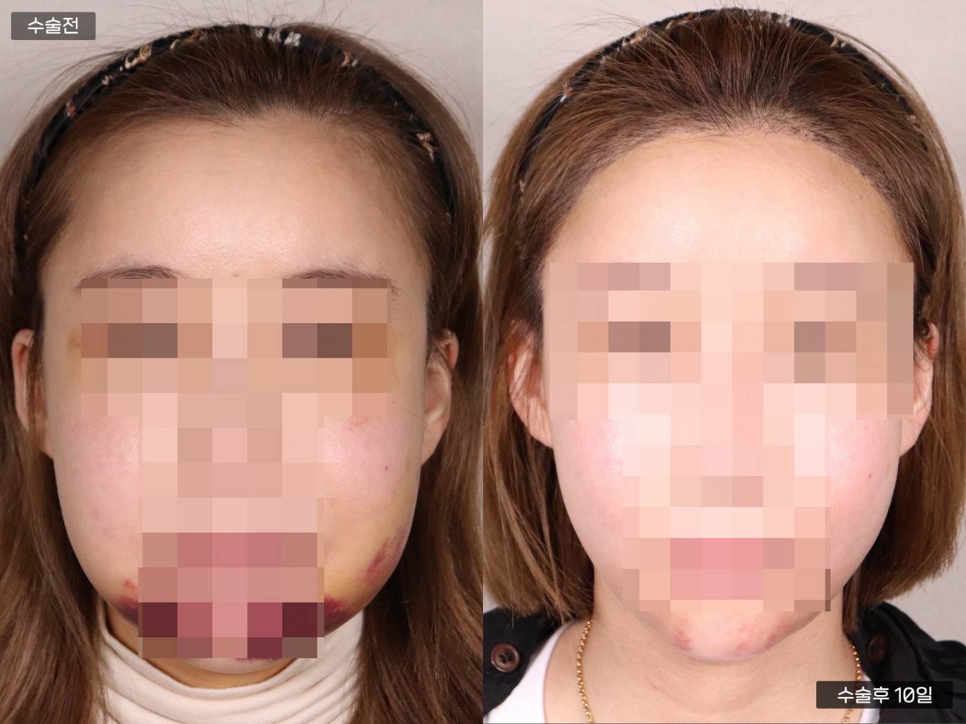 모발이식 [절개 모발이식(4000모)]