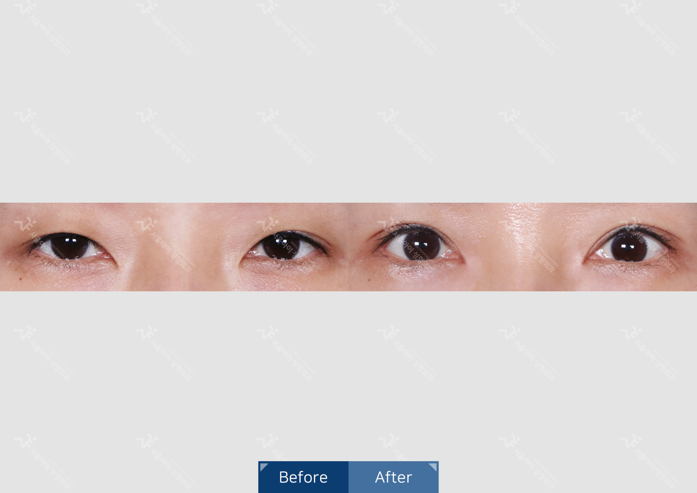 눈성형 [자연유착 쌍꺼풀 + 뒷밑트임]