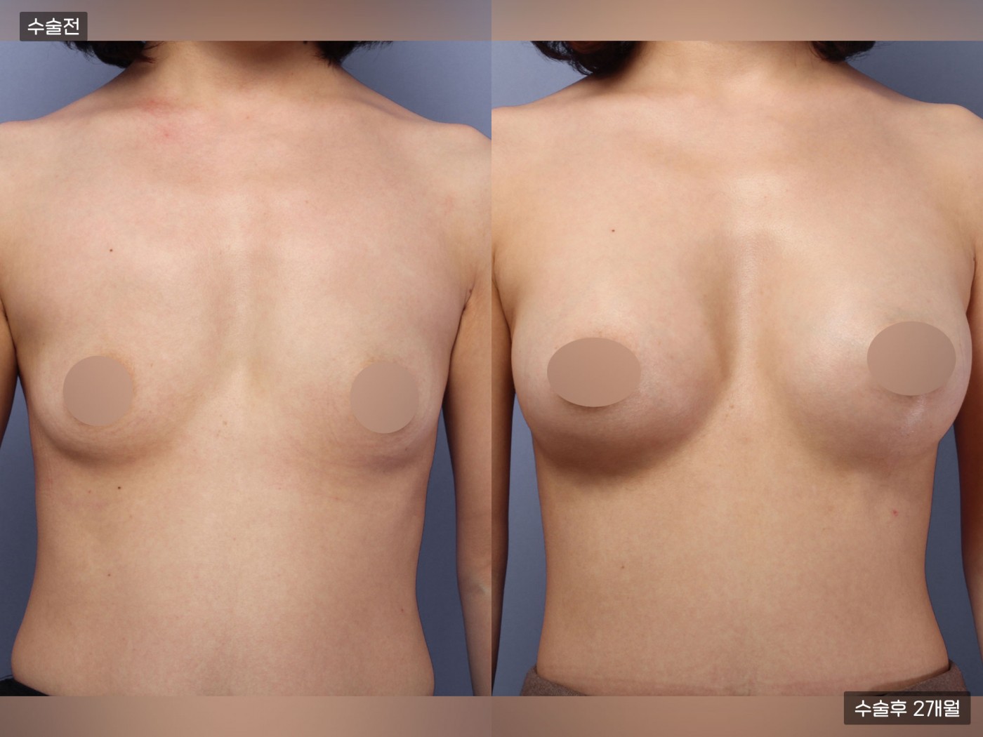 가슴성형 [내추럴가슴보형물]