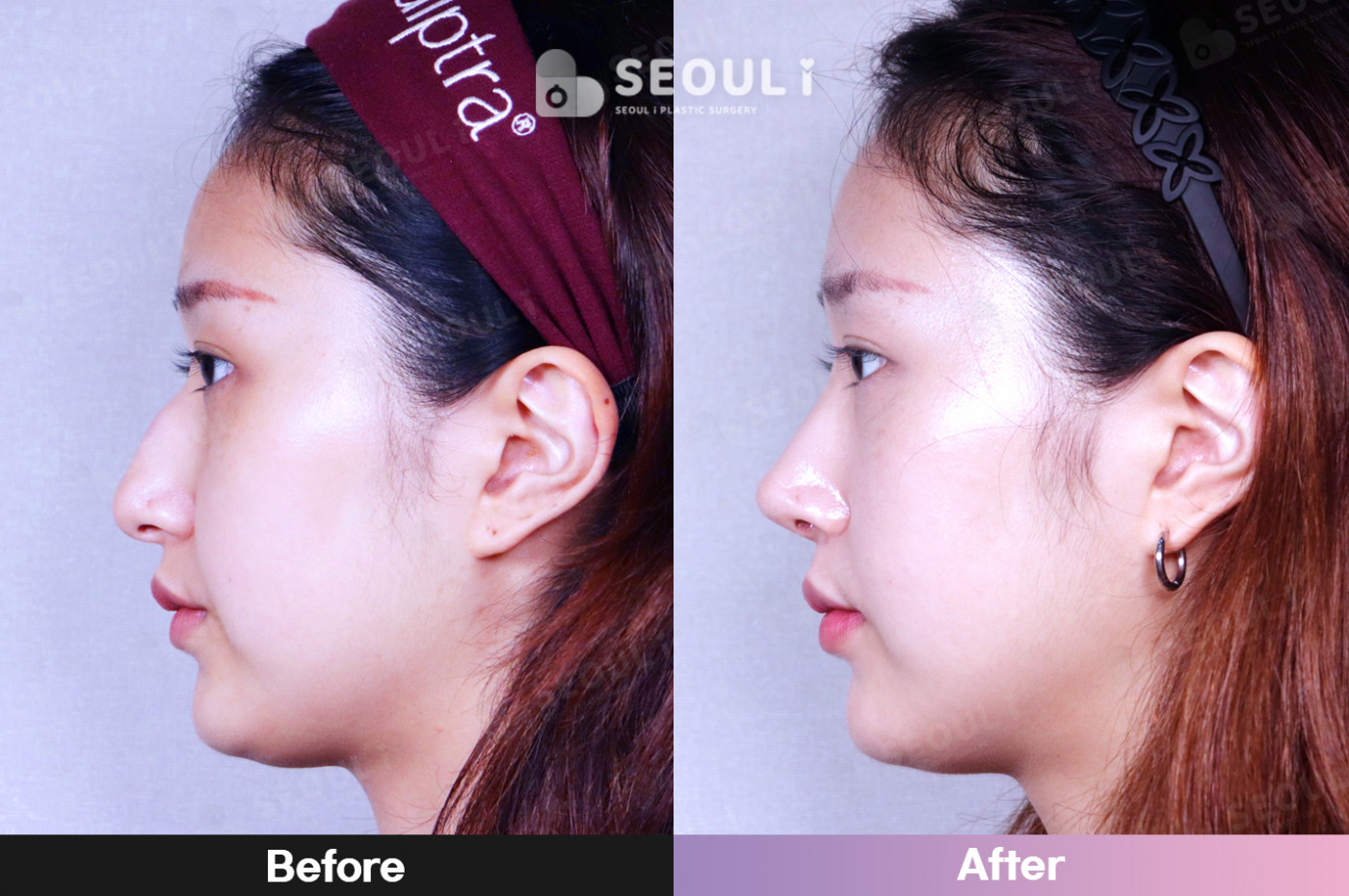 코끝(비중격) + 콧볼 축소술 + 매부리 교정