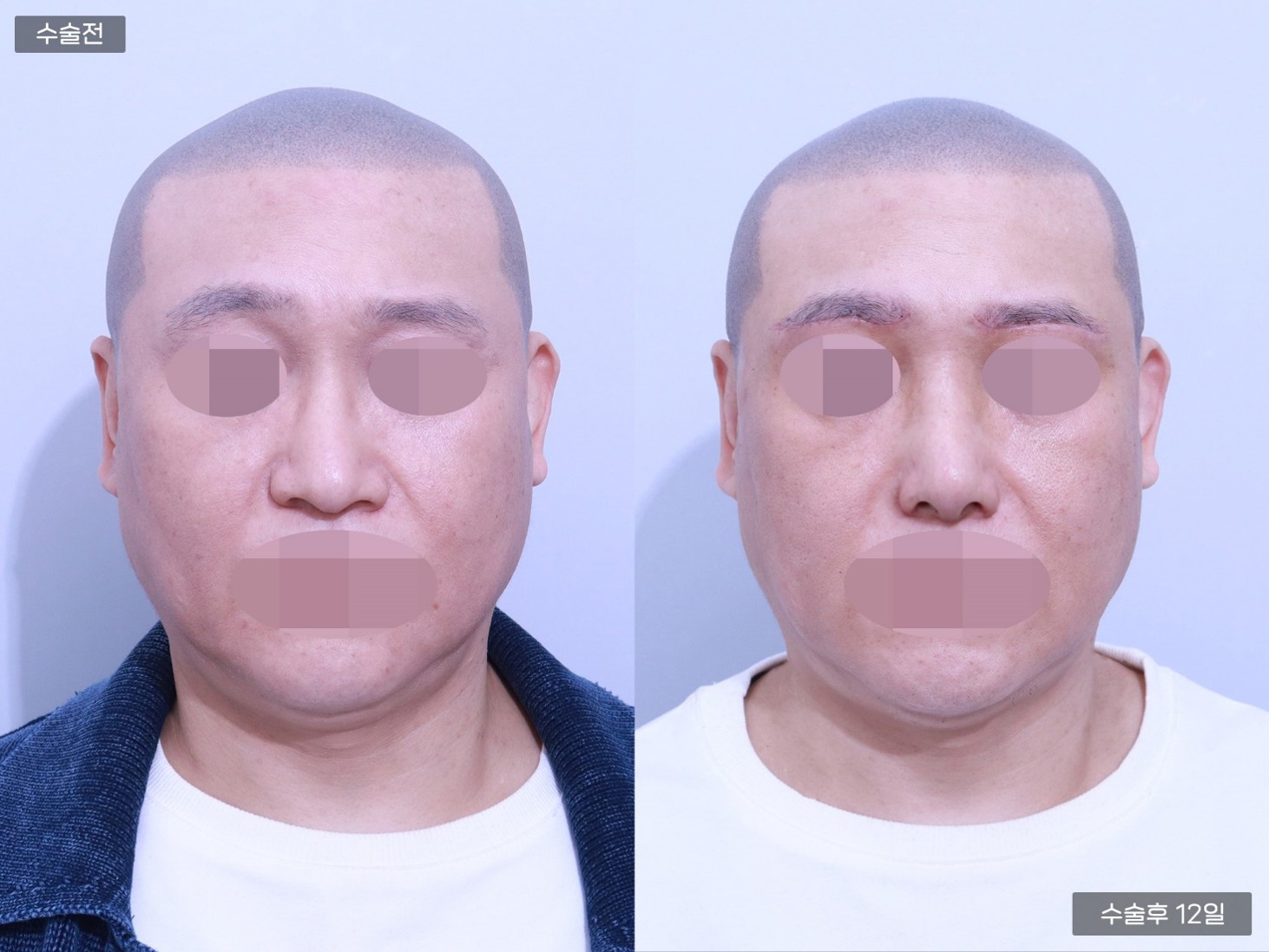 콧대교정 + 콧볼축소술