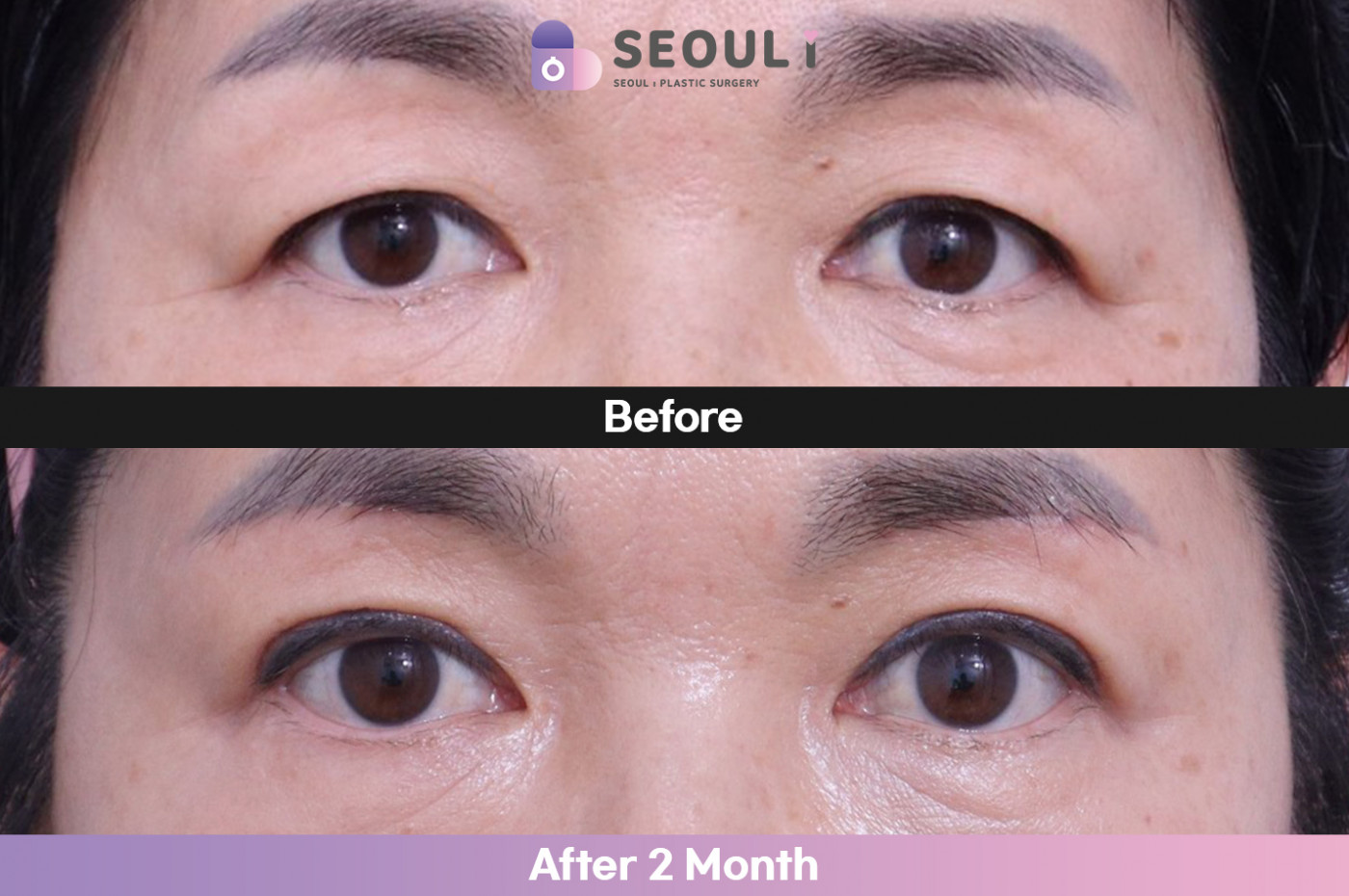 눈성형 [안검하수 + 눈매교정]