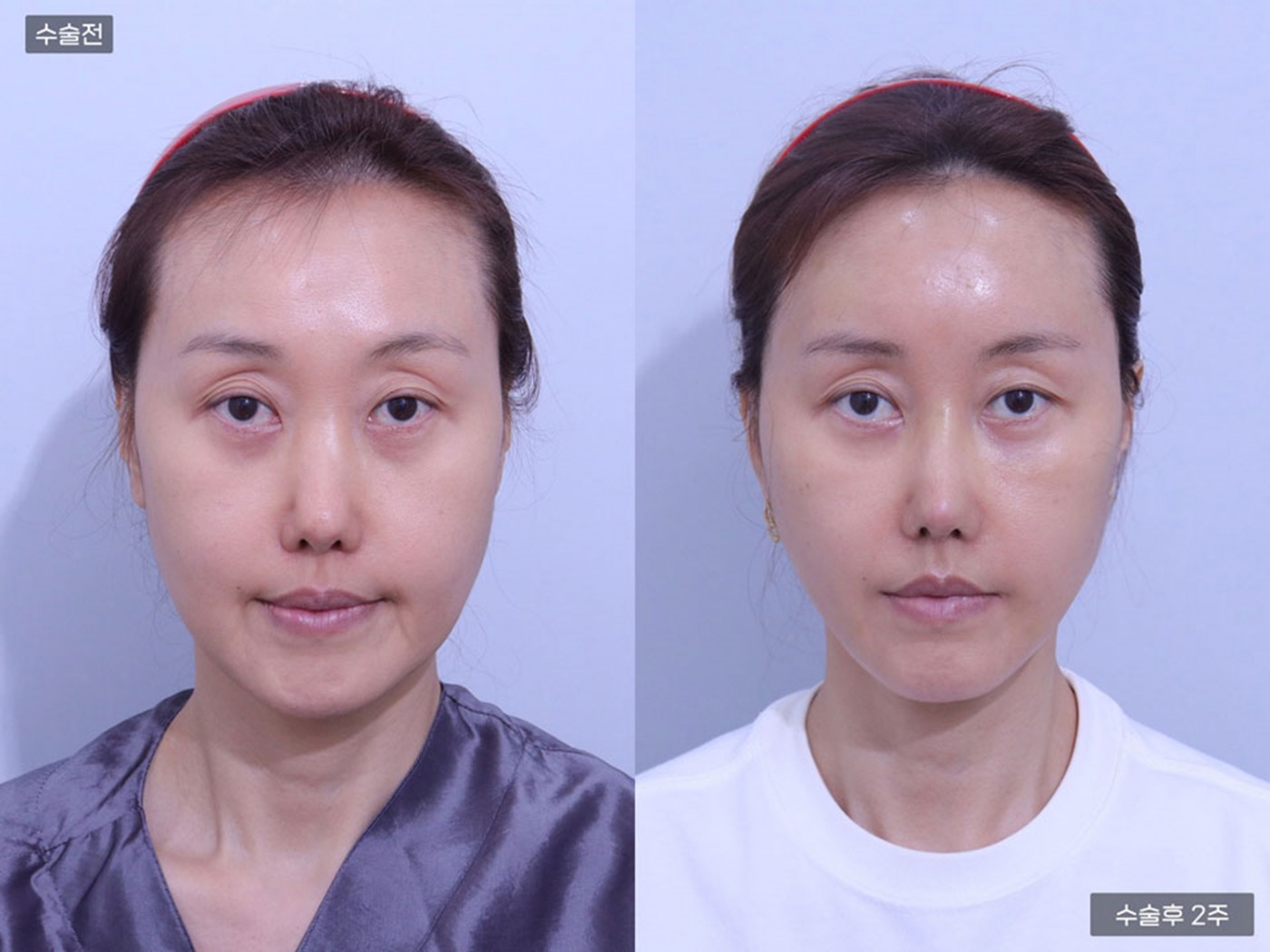 리프팅 [실리프팅]