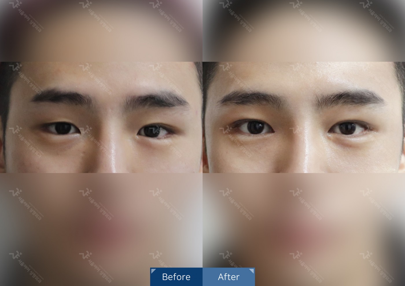 눈성형 [자연유착 + 앞트임 + 안검하수]
