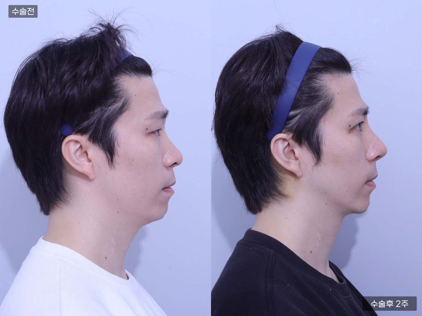 복코 + 코끝(비중격) + 콧볼축소 + 매부리코