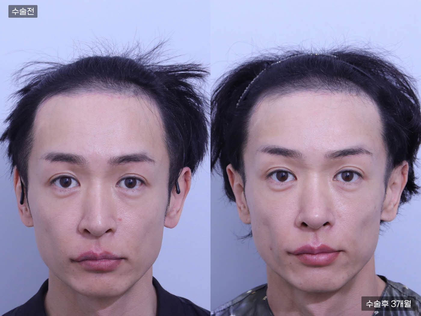 모발이식[절개 모발이식(5000모)]