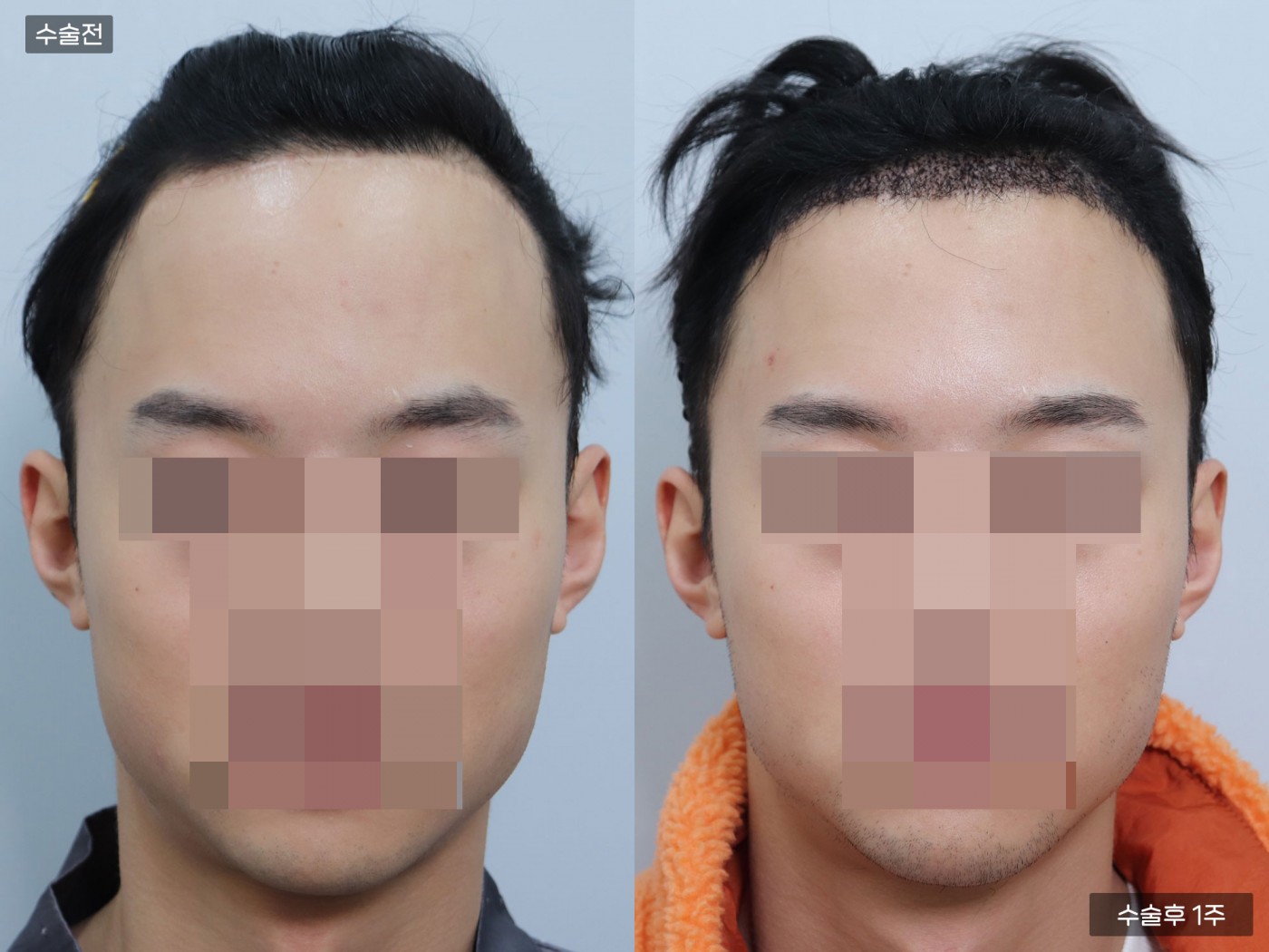 모발이식 [비절개 모발이식(4000모)]