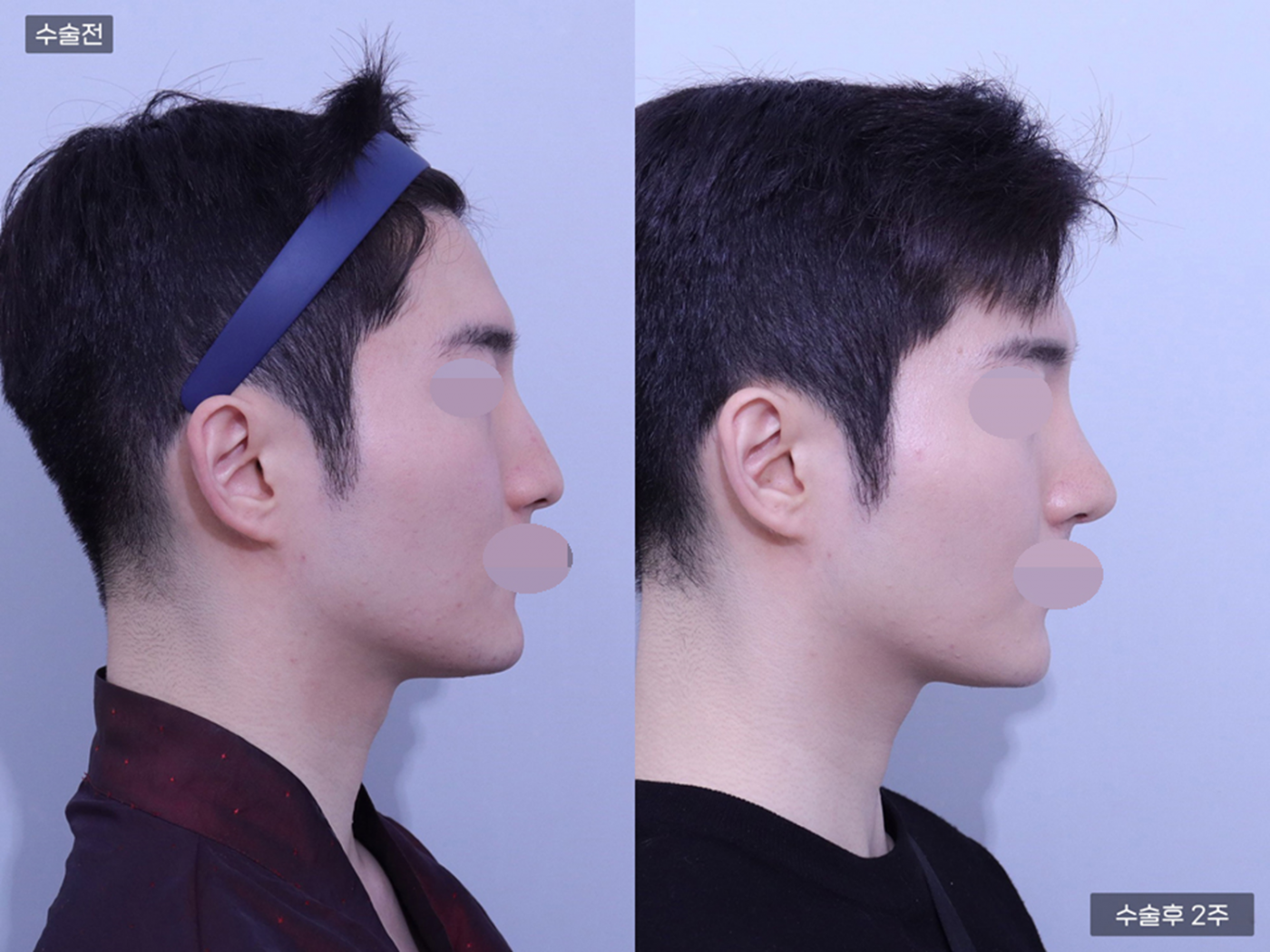 코끝(비중격) + 매부리코 + 콧볼축소