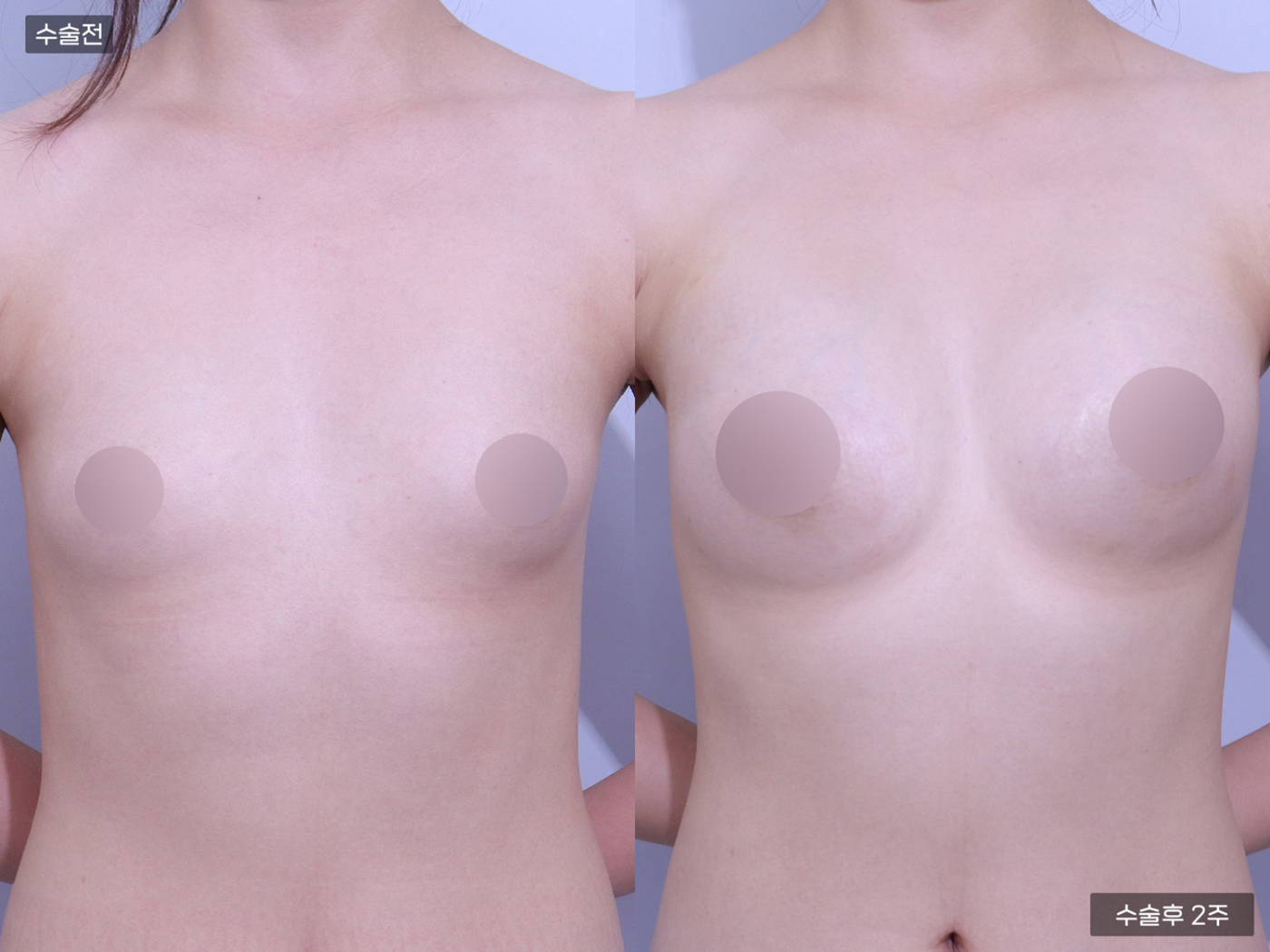 가슴성형 [가슴지방이식(300CC + 300CC)]