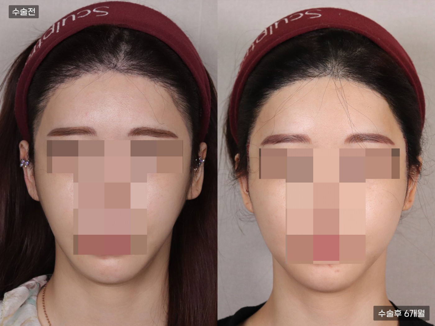 모발이식 [비절개 모발이식(1000모)]