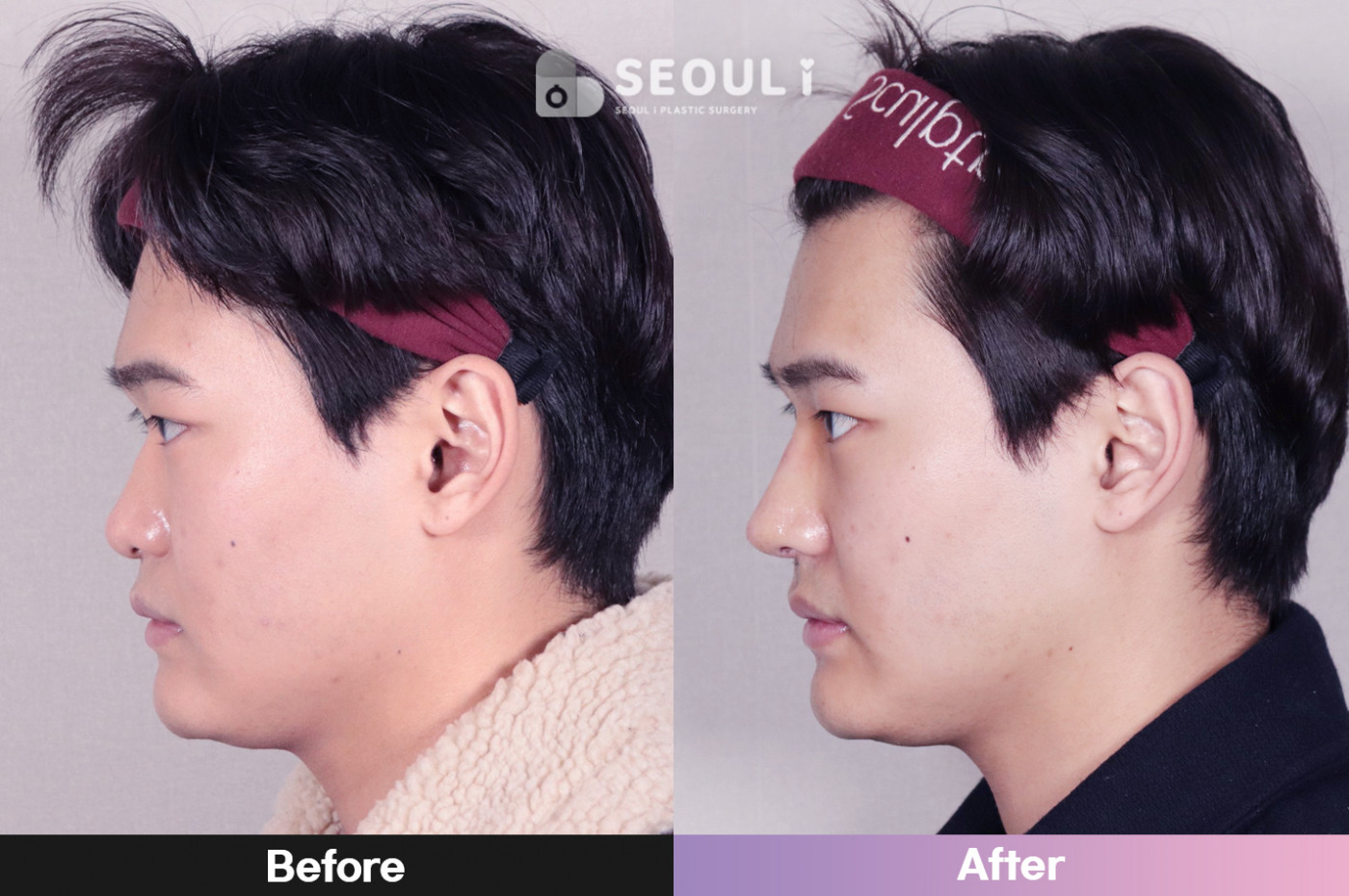 코끝(비중격) + 콧볼 축소술 + 매부리 교정