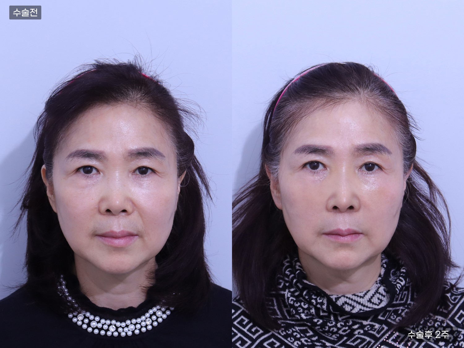 코끝(비중격) + 콧대