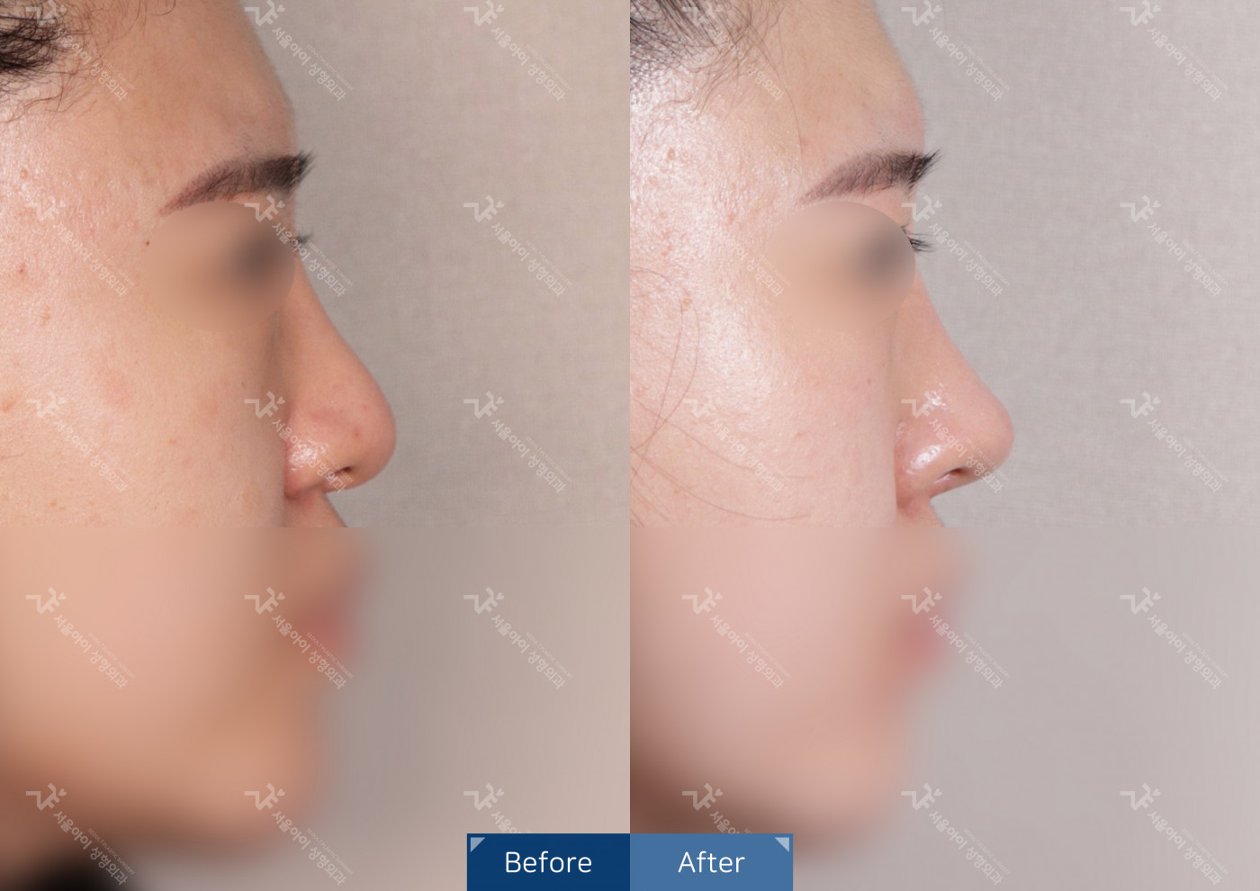 코성형[콧대+코끝+복코교정]