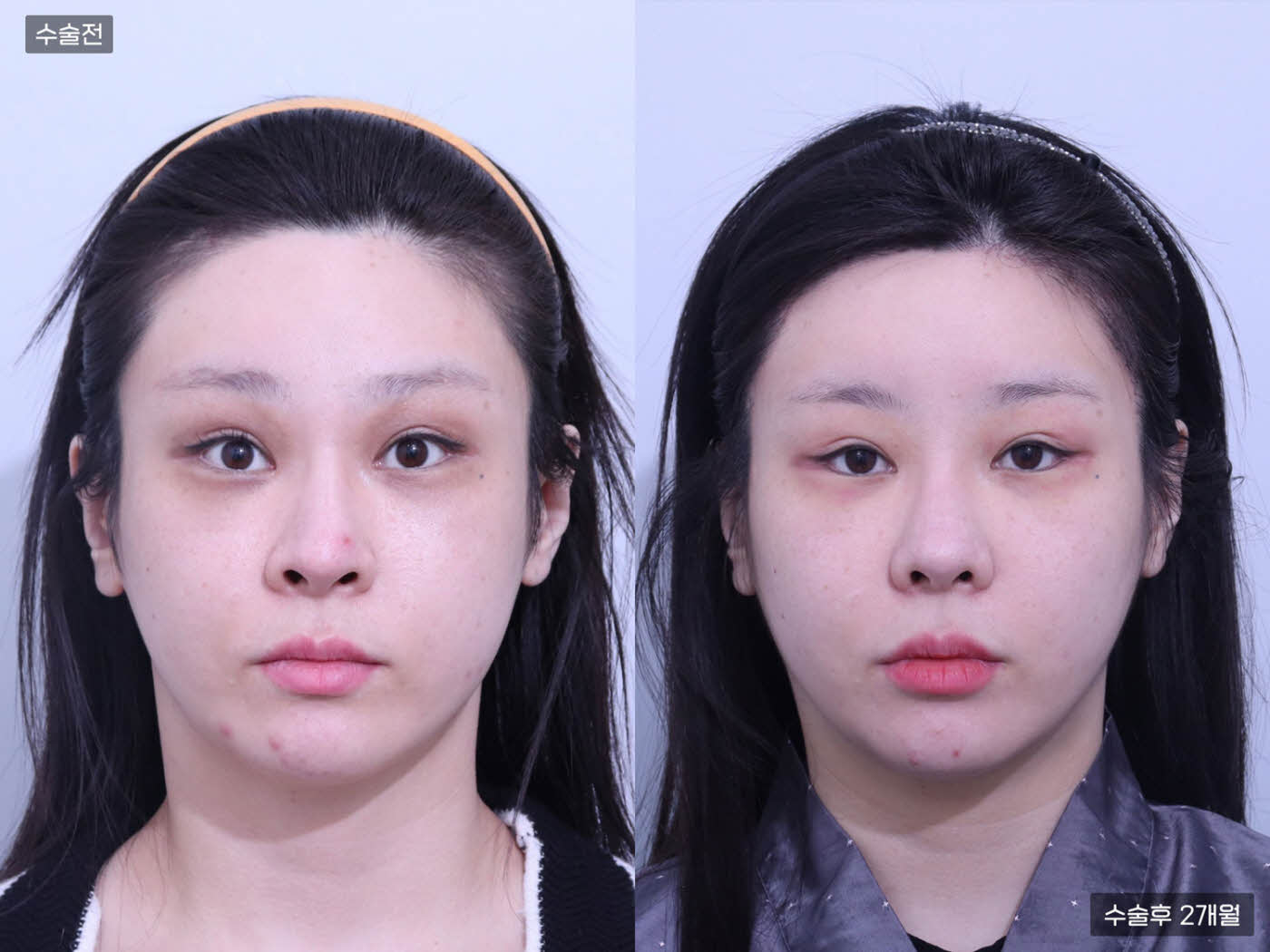 모발이식[절개 모발이식(4000모)]