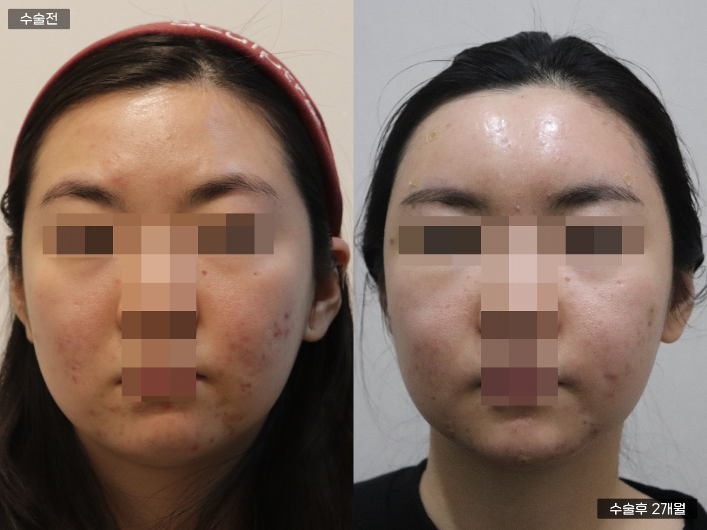 지방이식 [이마]