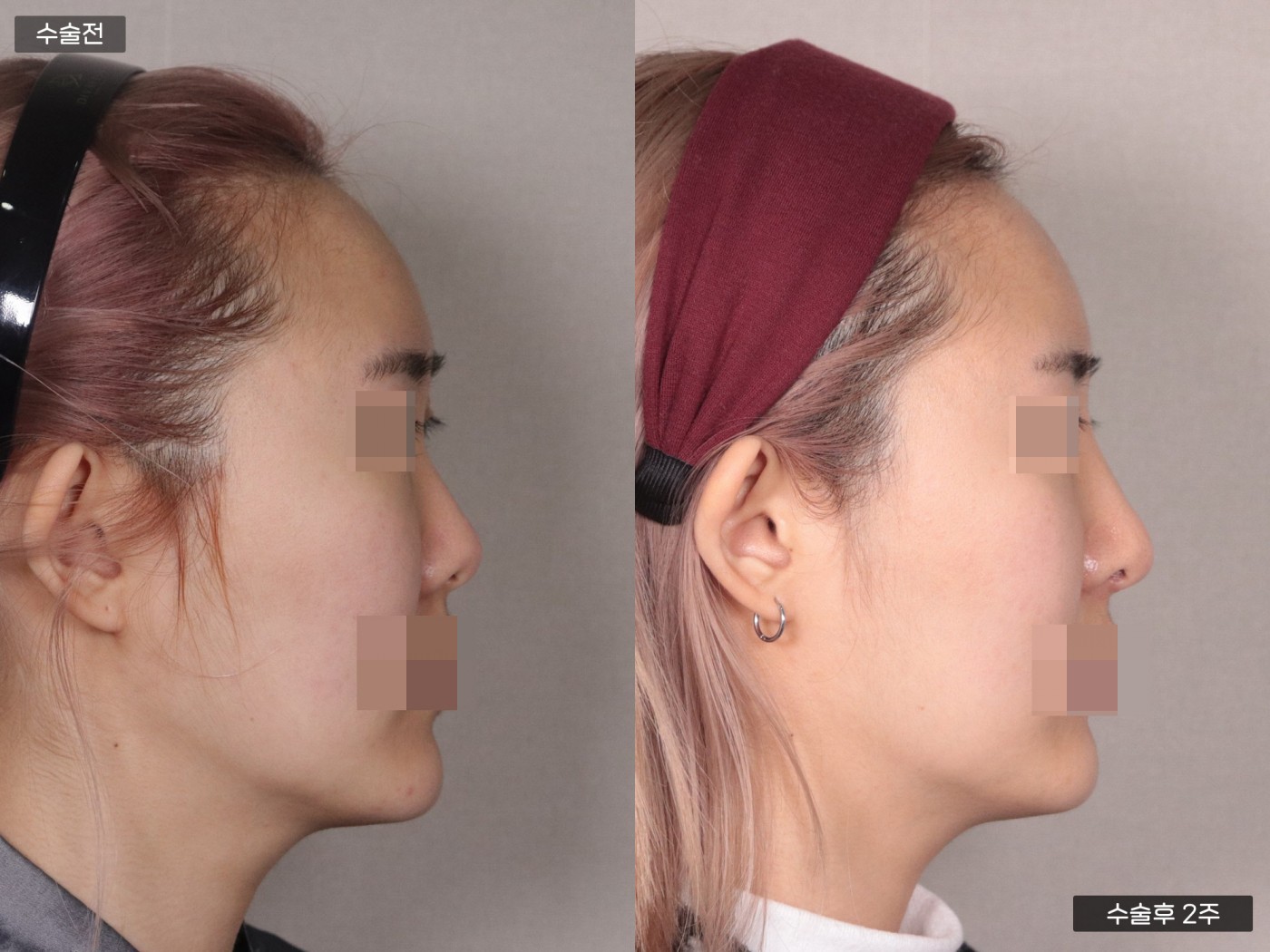 낮은코 + 복코 + 매부리코