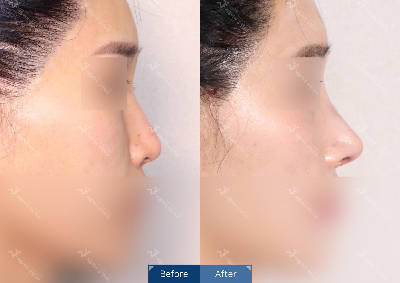 코성형 [융비술&코끝조각술(비중격)+매부리코교정]