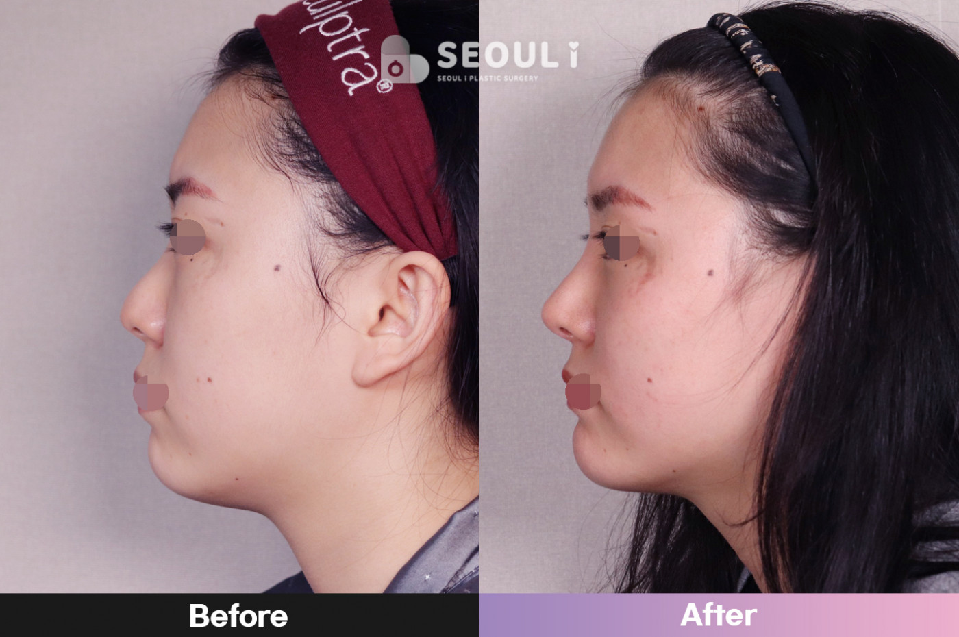 코끝(비중격) + 콧볼 축소술 + 매부리 교정