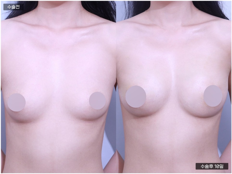 PRP 가슴지방이식 [ 200CC + 200CC ] 