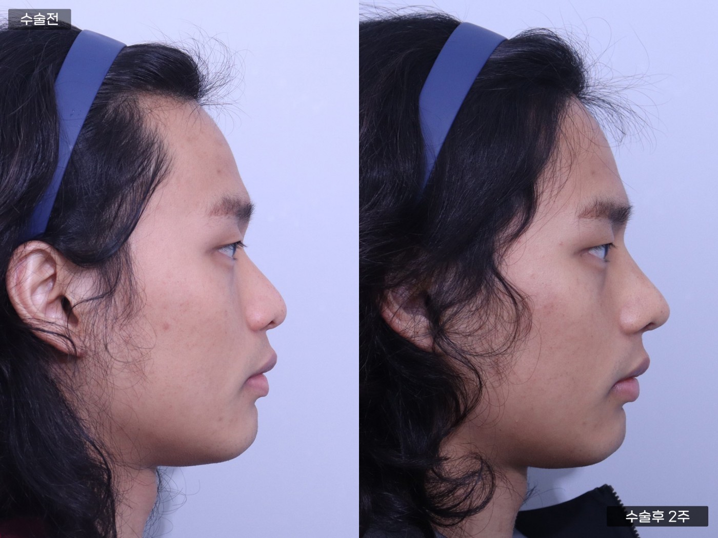 낮은코 + 복코 + 매부리코