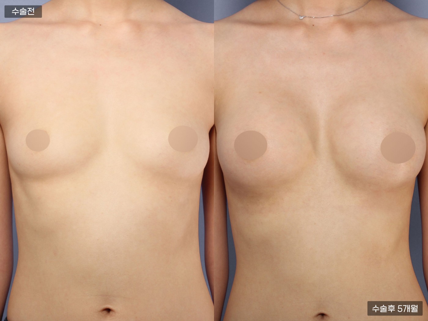 가슴성형 [내추럴가슴보형물]