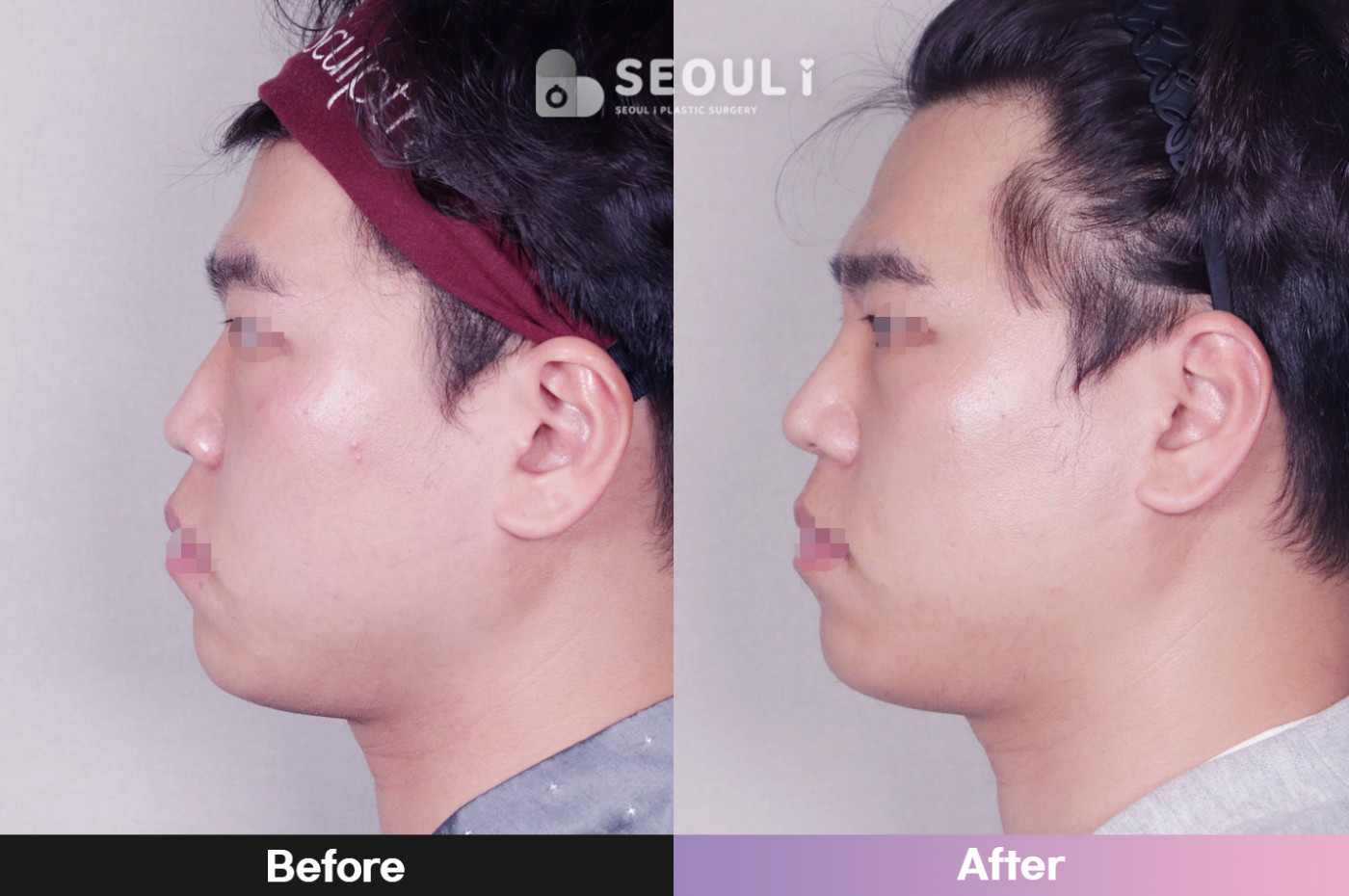코끝(비중격) + 콧볼 축소술 + 매부리 교정