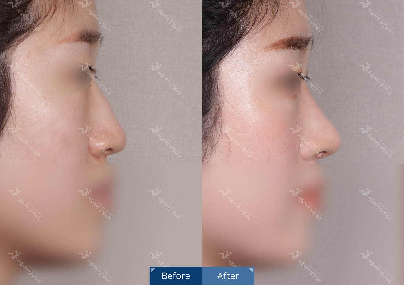 코성형 [코끝조각술+비중격+메부리코+복코교정술]
