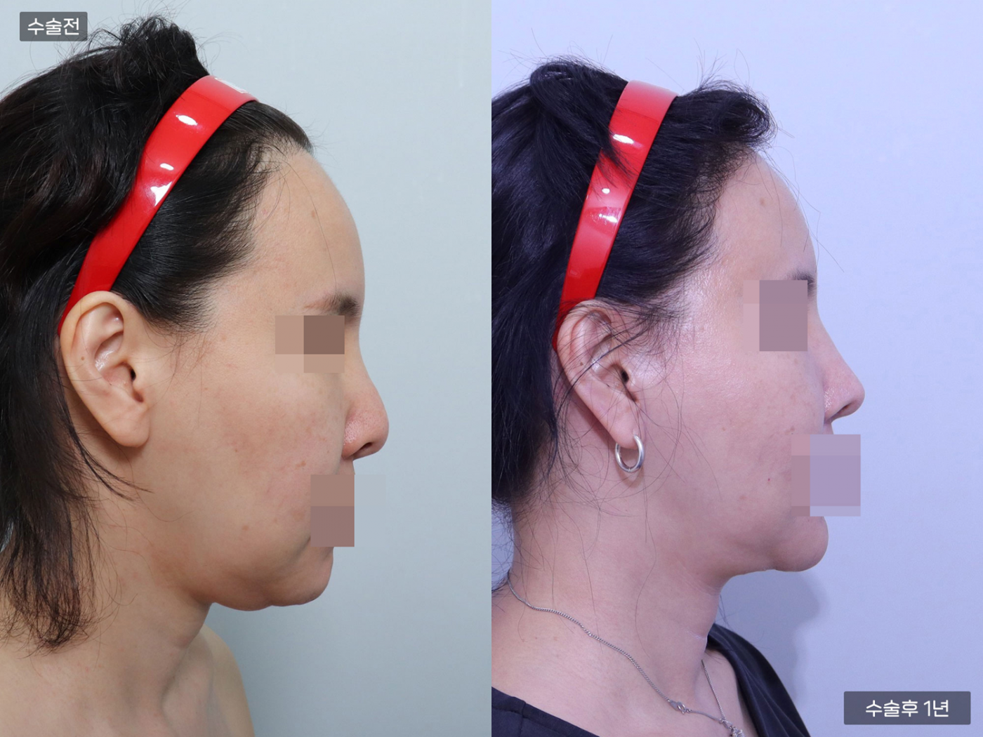 복코 + 매부리코 + 코끝(비중격)