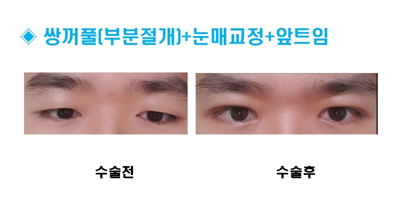 눈성형 [부분절개 쌍꺼풀 + 눈매교정 + 앞트임] 