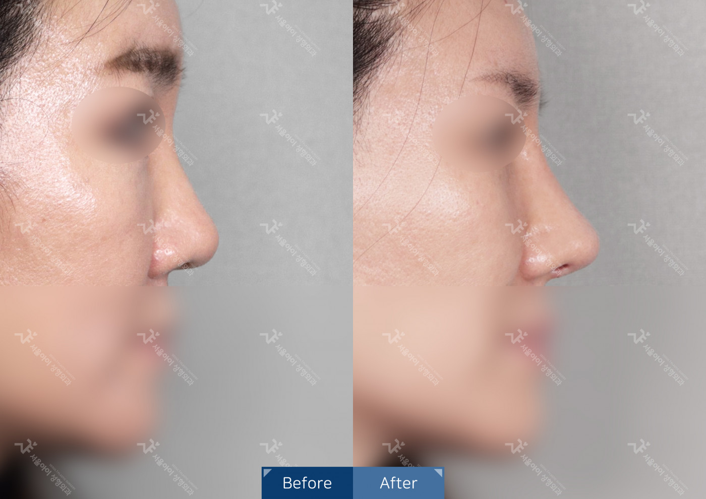 코성형 [융비술&코끝조각술(비중격)+복코교정술+메부리코]