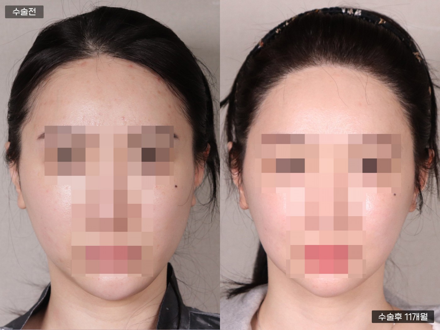 모발이식 [비절개 모발이식(3000모)]