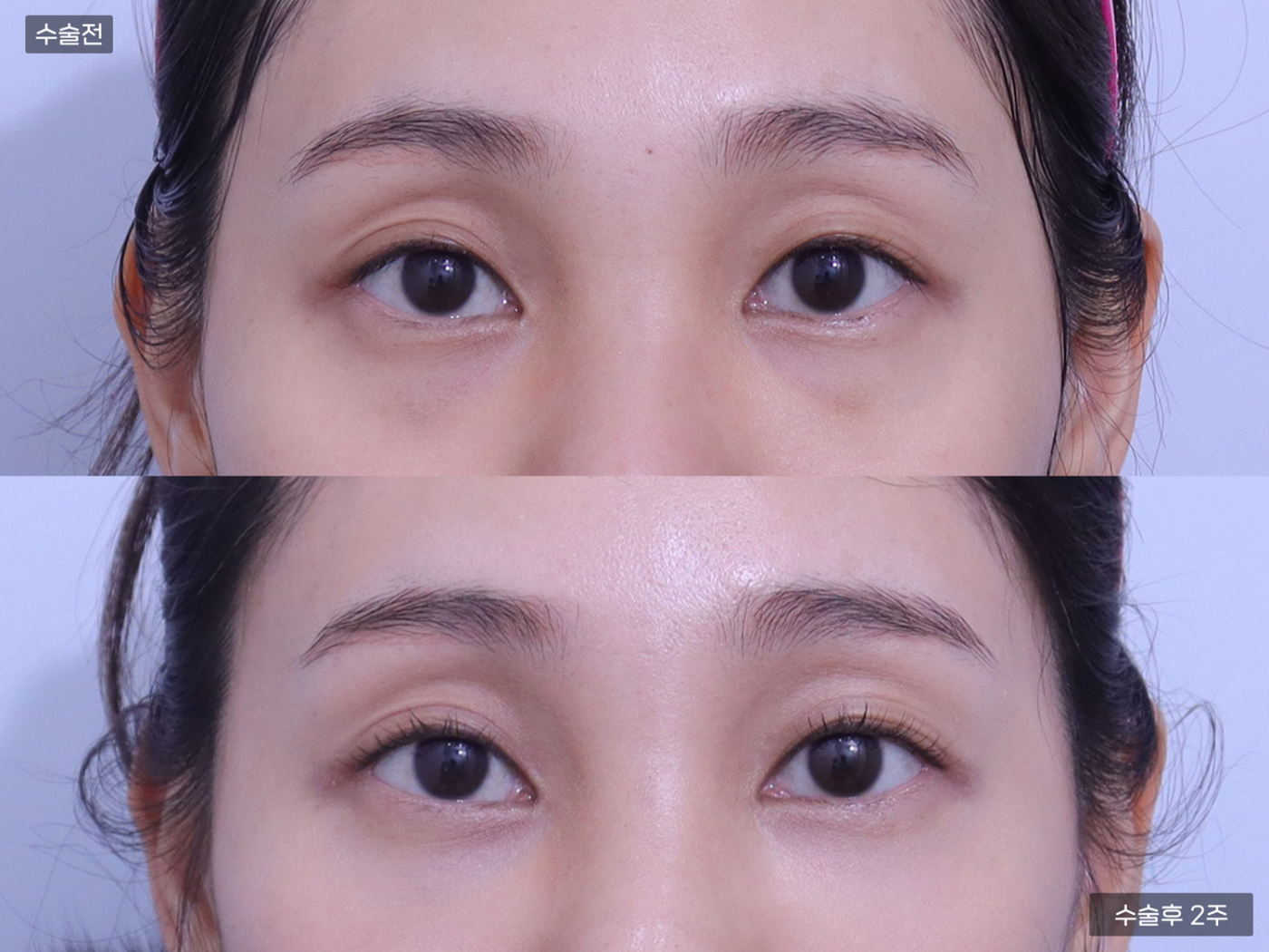 눈성형 [눈밑지방재배치]