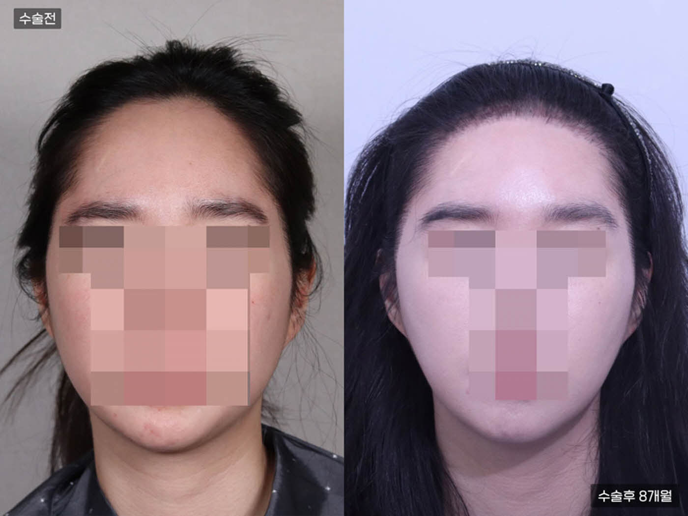 모발이식[비절개 모발이식(2000모)]