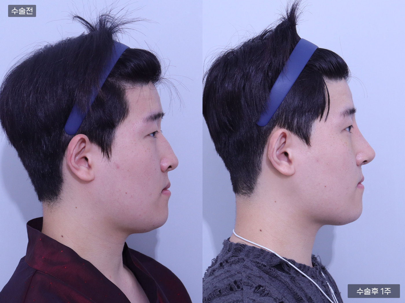 코끝 + 콧볼축소 + 복코 + 매부리코