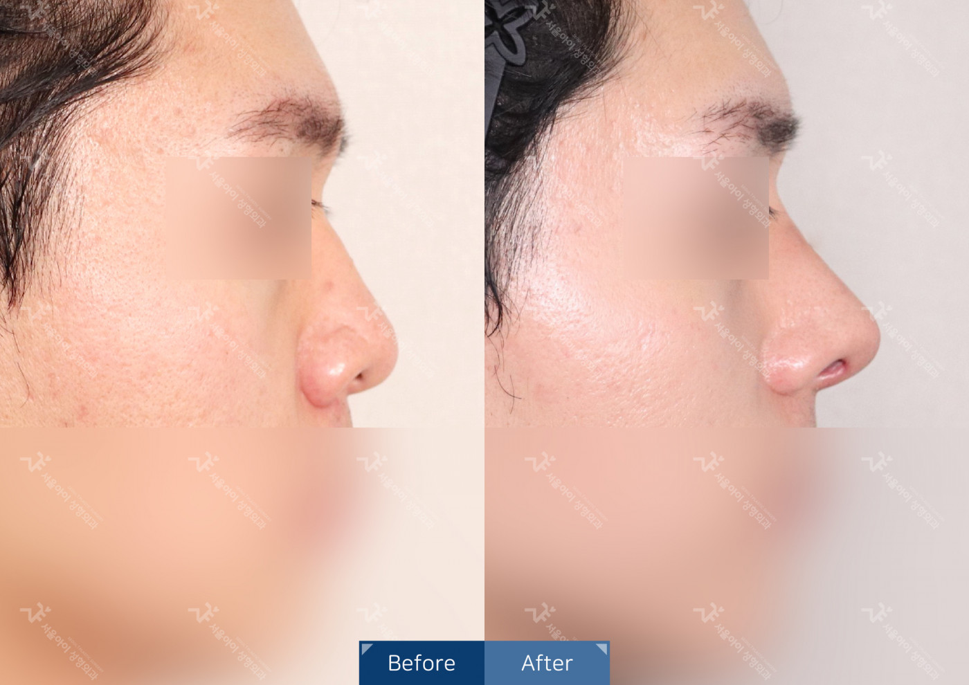 코성형 [융비술&코끝조각술(비중격)+복코교정+매부리코교정]