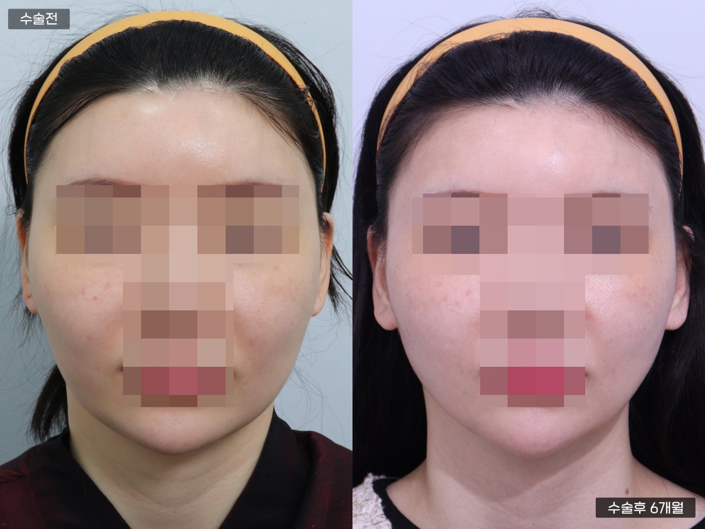 턱 지방흡입[이중턱 지방흡입]