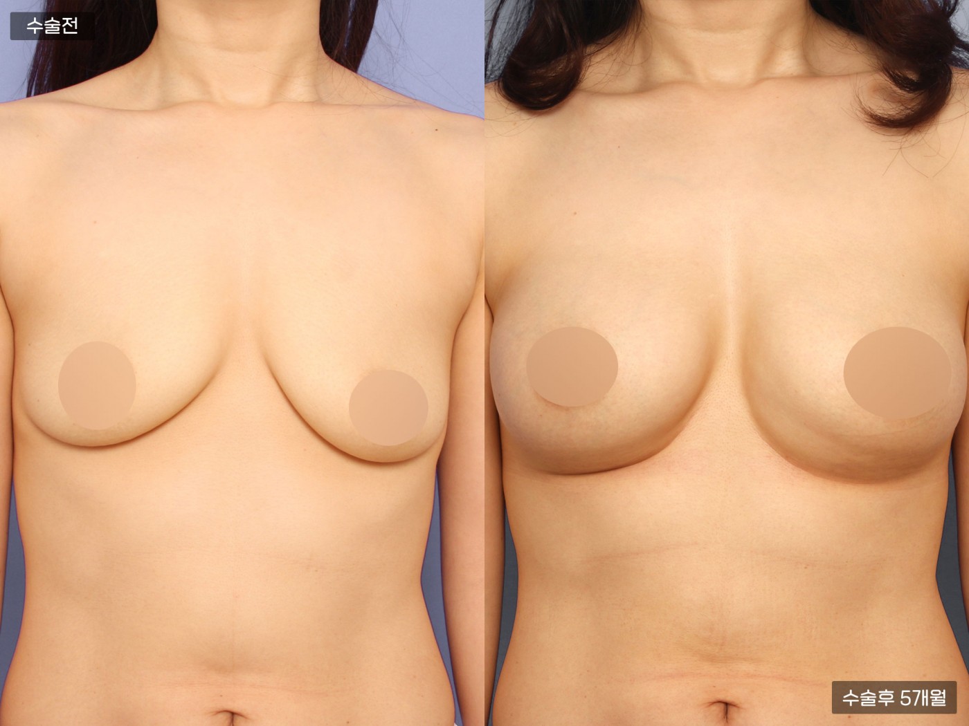 가슴성형 [내추럴가슴보형물]