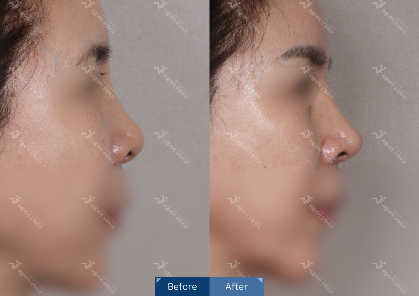 코성형 [코끝조각술+비중격+복코교정술+짧은코교정+메부리코]