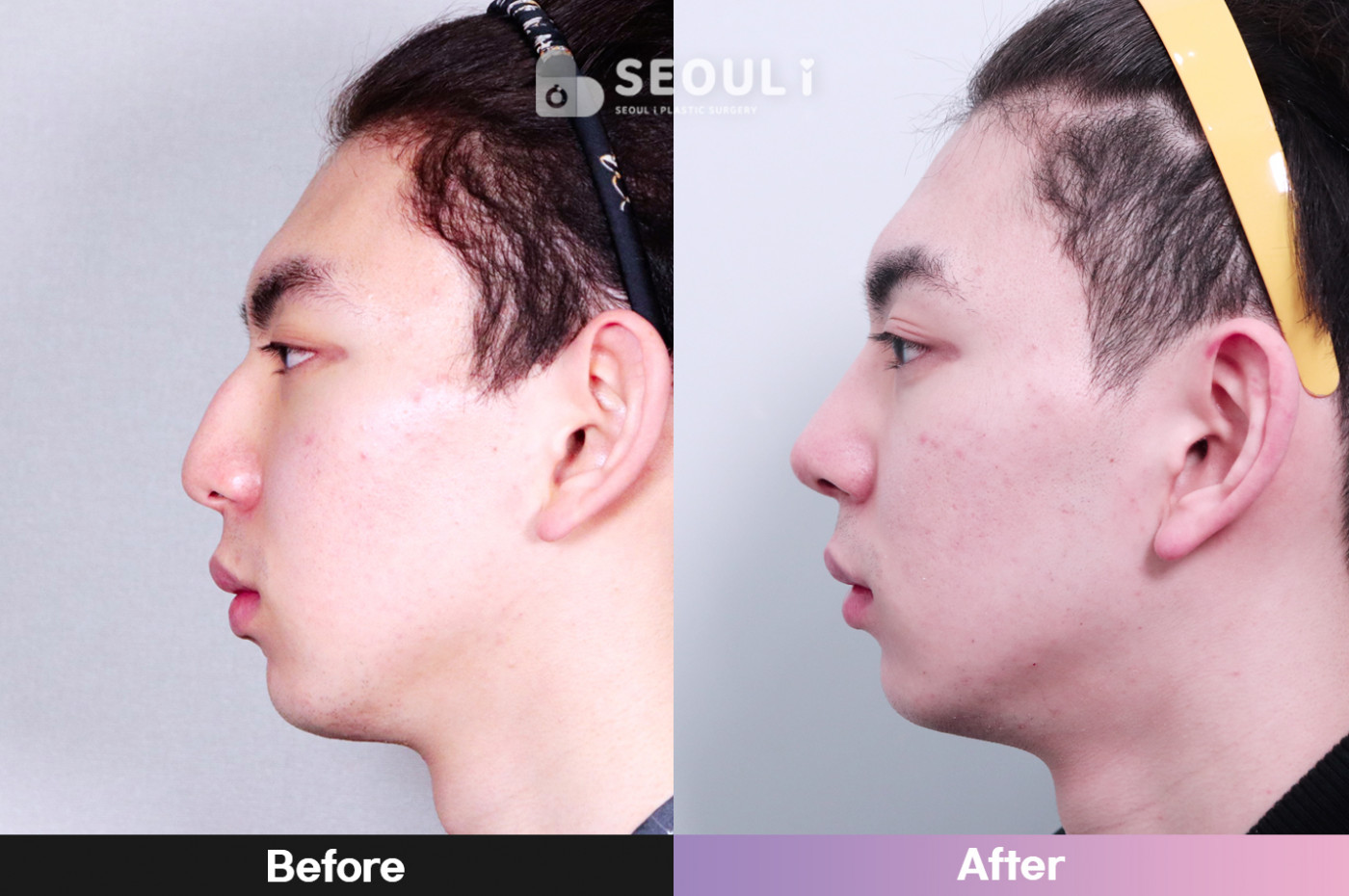코끝(비중격) + 콧볼 축소술 + 매부리 교정