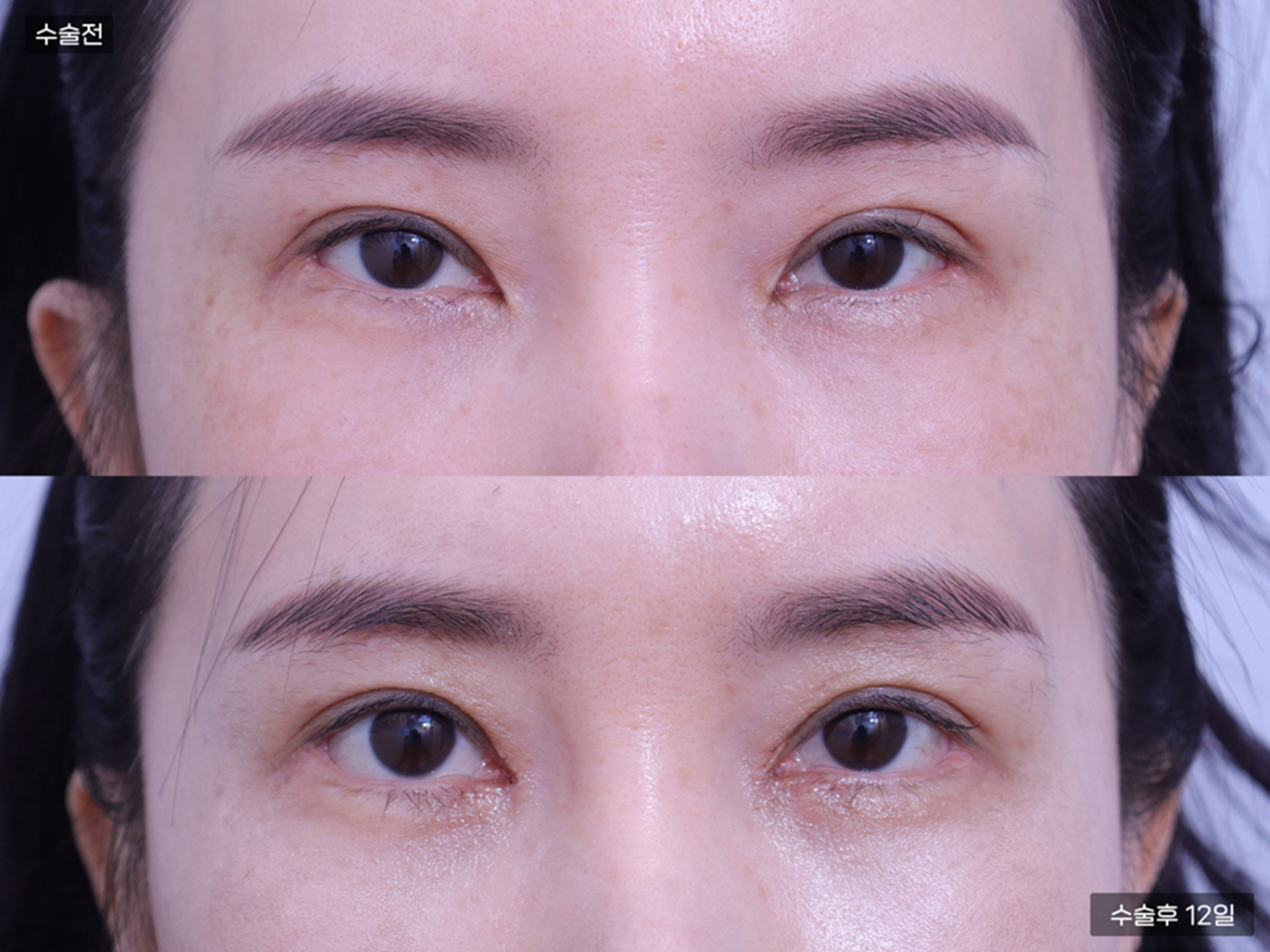 눈성형 [눈재수술 + 앞트임 + 뒷밑트임]
