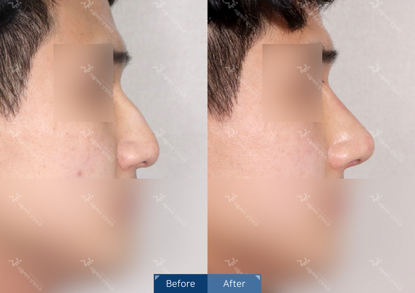 코성형 [코끝조각술(비중격)+복코교정+휜코교정+매부리코교정]