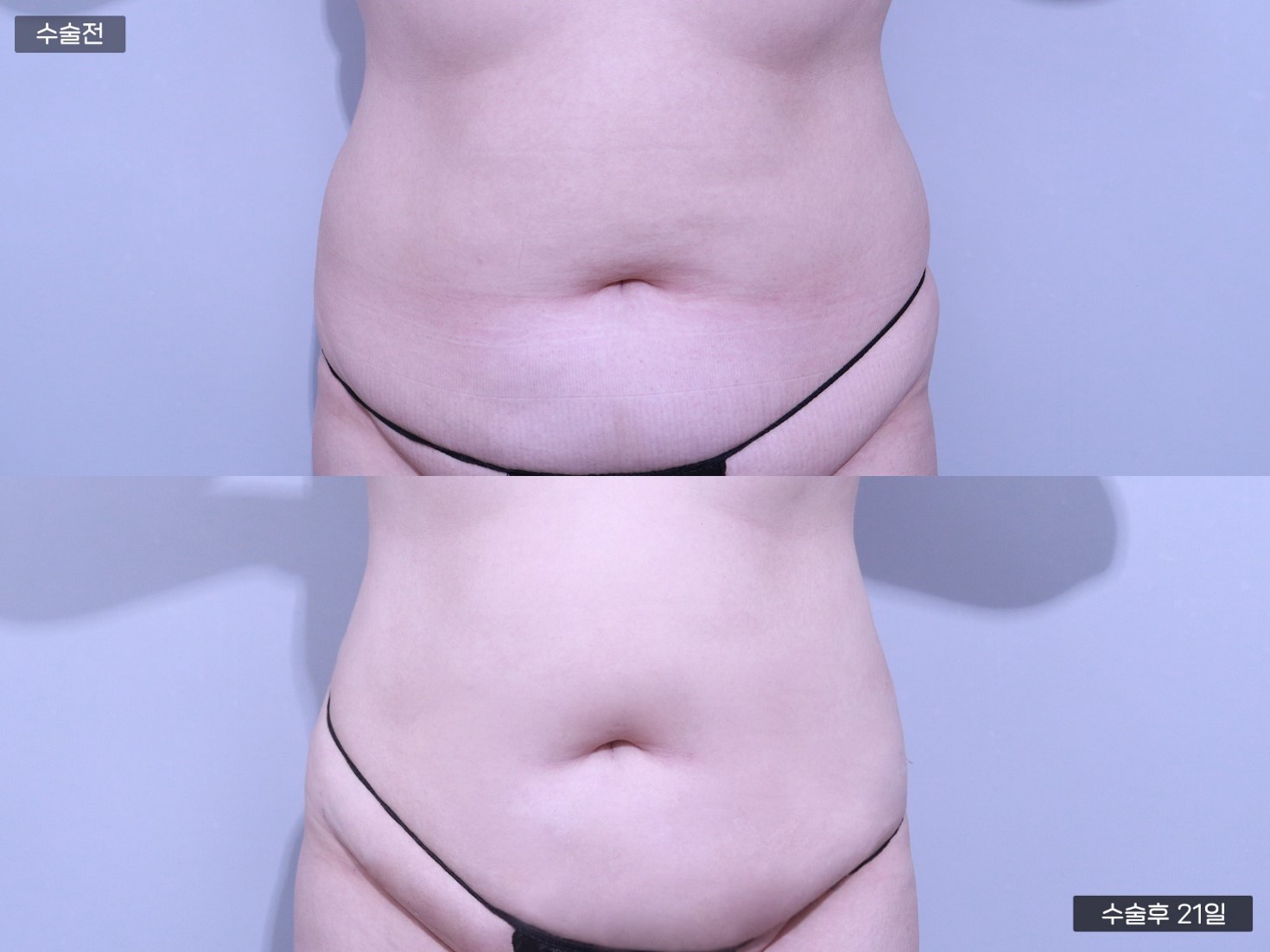 바디 지방흡입 [복부 + 옆구리 + 러브핸들 + 뒷구리]
