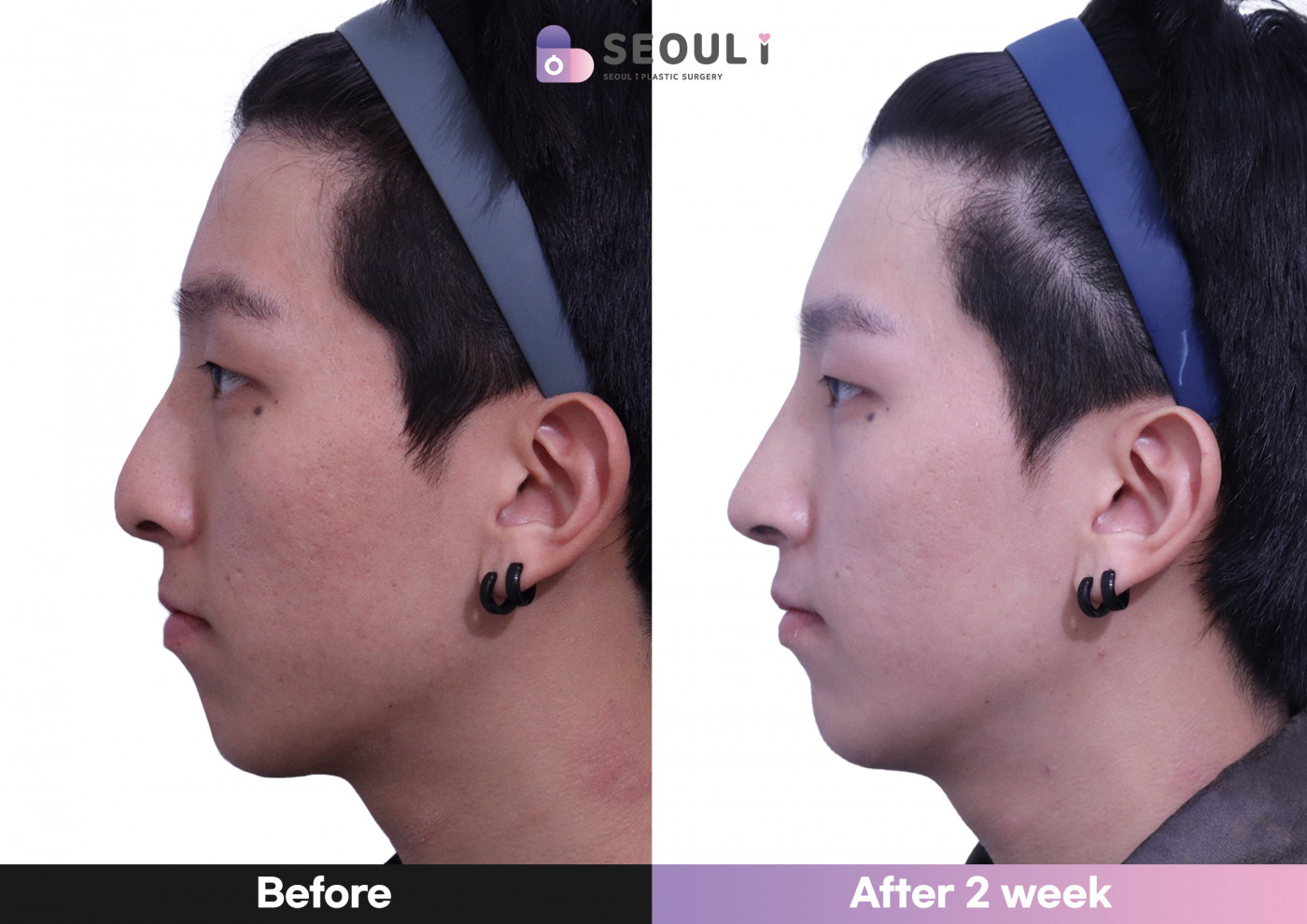 코끝(비중격) + 비공내리기