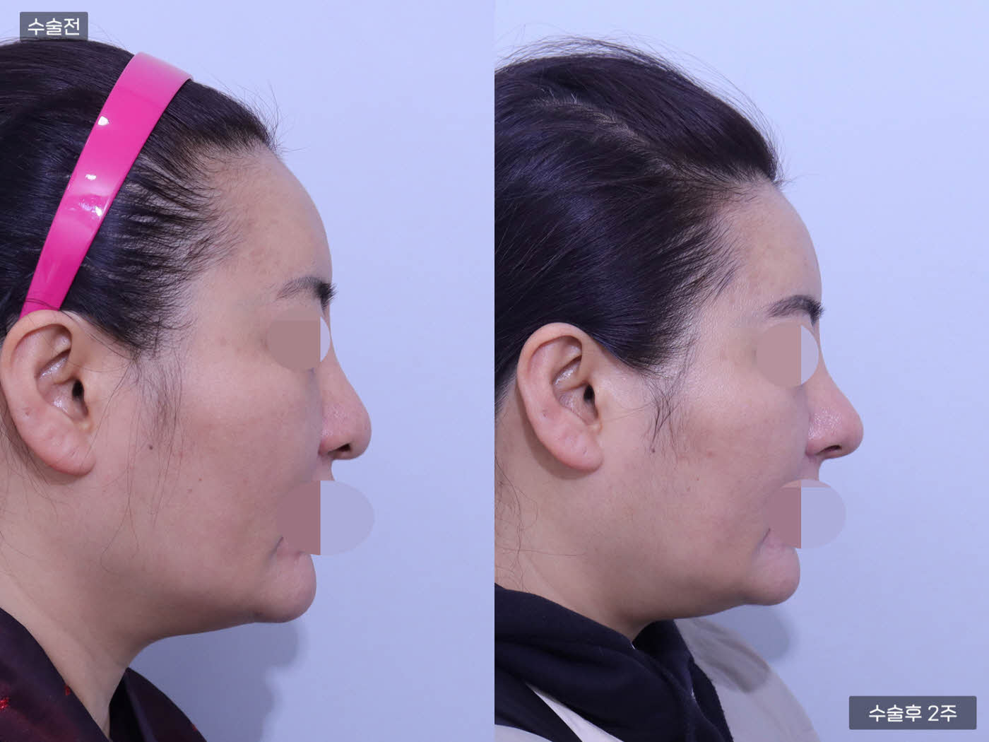 코끝 + 복코 + 매부리코 + 콧볼축소