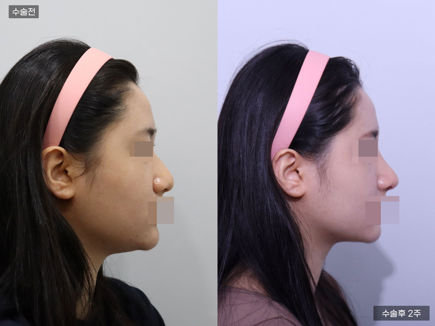 코끝 + 매부리코 + 복코