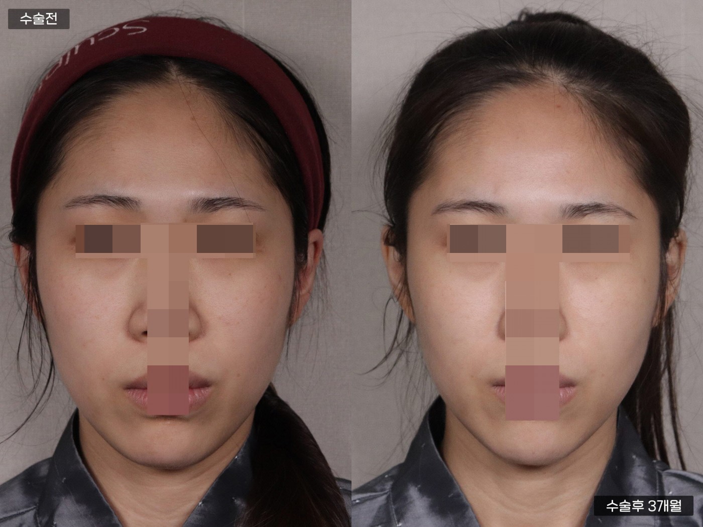 지방이식 [풀페이스]