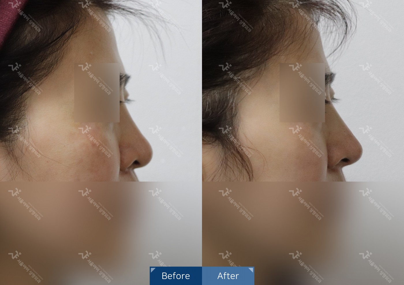 코성형 [비절개콧볼축소+하이코]